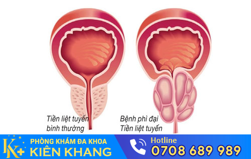 Phì Đại Tuyến Tiền Liệt – Căn Bệnh Nguy Hiểm Chớ Xem Thường