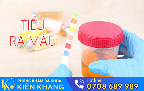 Tiểu Ra Máu Ở Phụ Nữ Là Bệnh Gì?