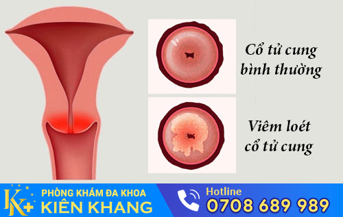 Viêm Loét Cổ Tử Cung Là Bệnh Gì?