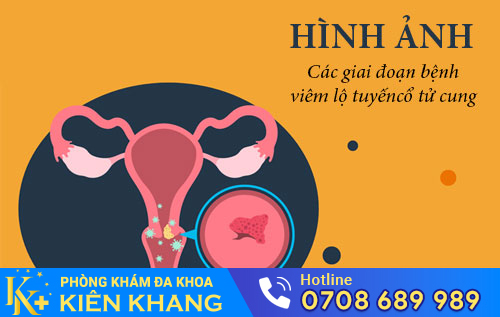 Hình Ảnh Các Giai Đoạn Bệnh Viêm Lộ Tuyến Cổ Tử Cung