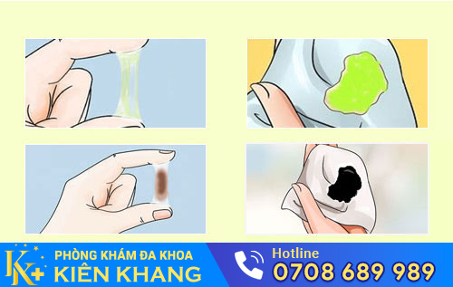 Thận Trọng Khi Huyết Trắng Có Màu, Mùi Hôi Và Ngứa
