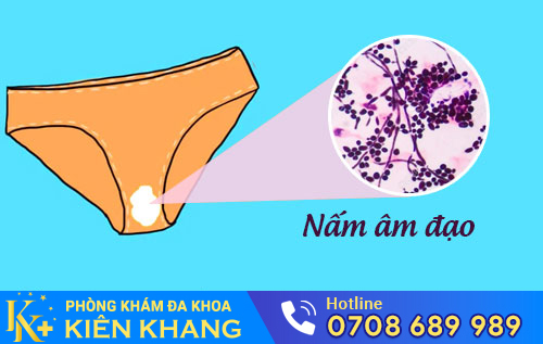 Nấm Âm Đạo: Dấu Hiệu Và Cách Hỗ Trợ Điều Trị Hiệu Quả