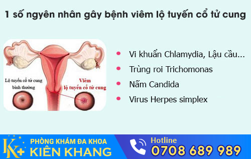 Nguyên Nhân Viêm Lộ Tuyến Là Gì? Có Hỗ Trợ Chữa Được Không?