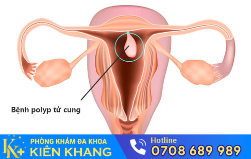 Polyp Tử Cung Cách Hỗ Trợ Điều Trị Ra Sao?