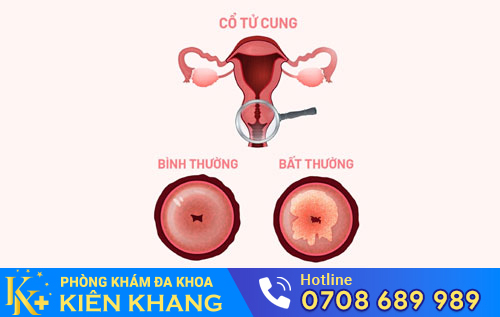 Viêm Cổ Tử Cung – Nguyên Nhân, Triệu Chứng Và Cách Điều Trị Hiệu Quả