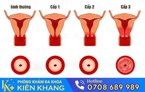 Viêm Cổ Tử Cung Bệnh Nguy Hiểm Có Thể Gây Vô Sinh Ở Nữ Giới