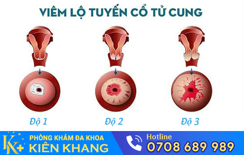 Viêm Lộ Tuyến Cổ Tử Cung: Không Hỗ Trợ Chữa Sớm Dễ Vô Sinh
