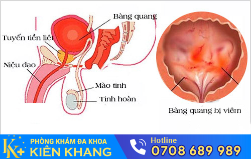 Những Dấu Hiệu Cho Thấy Bạn Đang Mắc Bệnh Bàng Quang