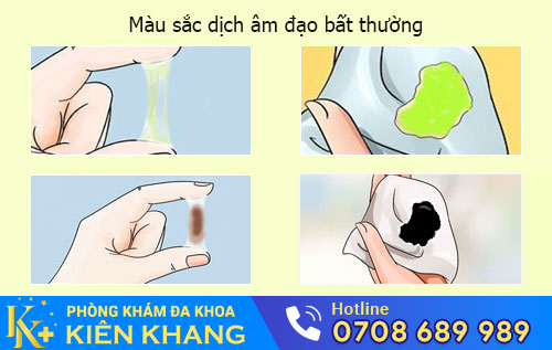 Dịch Âm Đạo – Dấu Hiệu Cảnh Báo Bệnh Phụ Khoa Đang Tiềm Ẩn