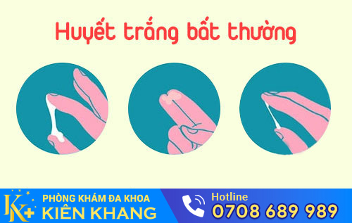 Nhận Biết Nhanh Các Dấu Hiệu Huyết Trắng Bất Thường