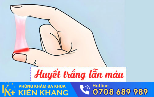 Huyết Trắng Lẫn Máu – Không Được Chủ Quan!