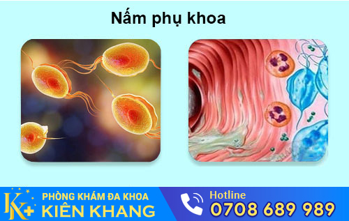 Nấm Phụ Khoa: Làm Sao Để Đẩy Lùi Hiệu Quả?