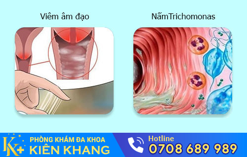 Nguyên Nhân Khí Hư Có Mùi Hôi Và Cách Hỗ Trợ Điều Trị Hiệu Quả