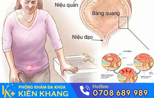 Tiểu Đêm Nhiều Ở Phụ Nữ Là Dấu Hiệu Bệnh Gì?