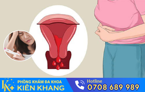 Cách Hỗ Trợ Điều Trị Rong Kinh Hiệu Quả