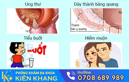 Viêm Bàng Quang Và Cách Hỗ Trợ Điều Trị Hiệu Quả