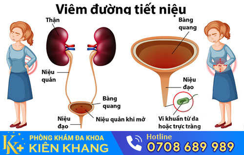 Viêm Đường Tiết Niệu Ở Nữ Bệnh Tưởng Nhẹ Mà Không Nhẹ