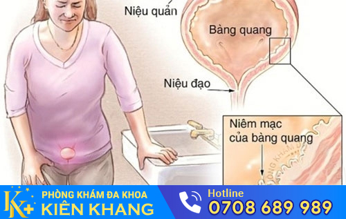 Viêm Đường Tiết Niệu Nữ: Triệu Chứng Và Phương Pháp Hỗ Trợ Điều Trị Hiệu Quả