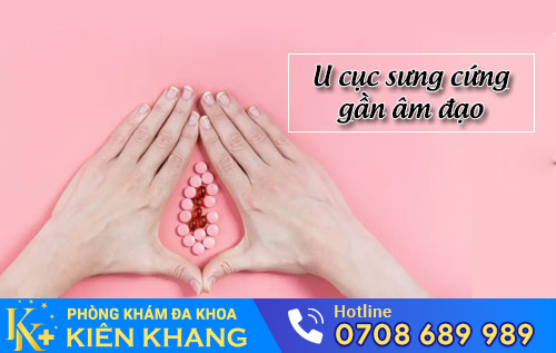 U Cục Sưng Cứng Gần Âm Đạo – Triệu Chứng Của Viêm Tuyến Bartholin