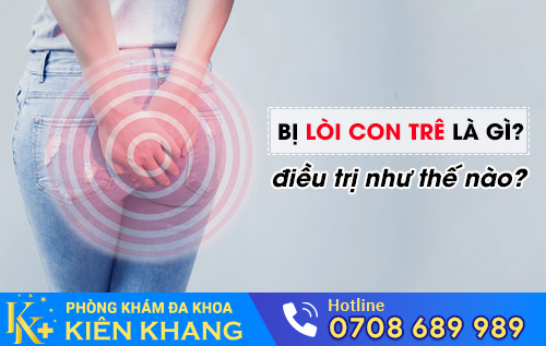 Bị Lòi Con Trê Là Gì? Điều Trị Như Thế Nào?